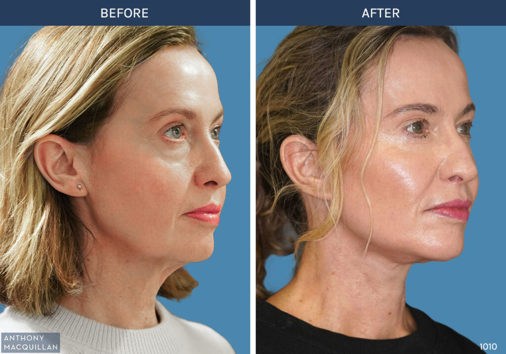 1010 - Deep Plane Face Lift with Deep Neck Lift by Anthony MacQuillan 45 Right