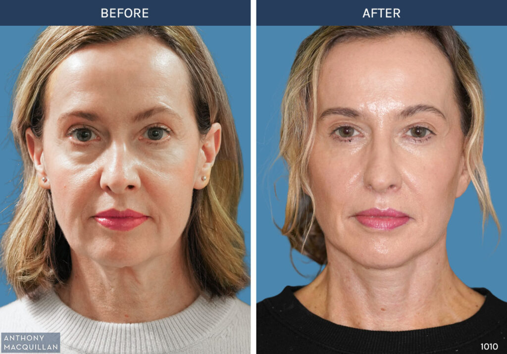 1010 - Deep Plane Face Lift with Deep Neck Lift by Anthony MacQuillan Front