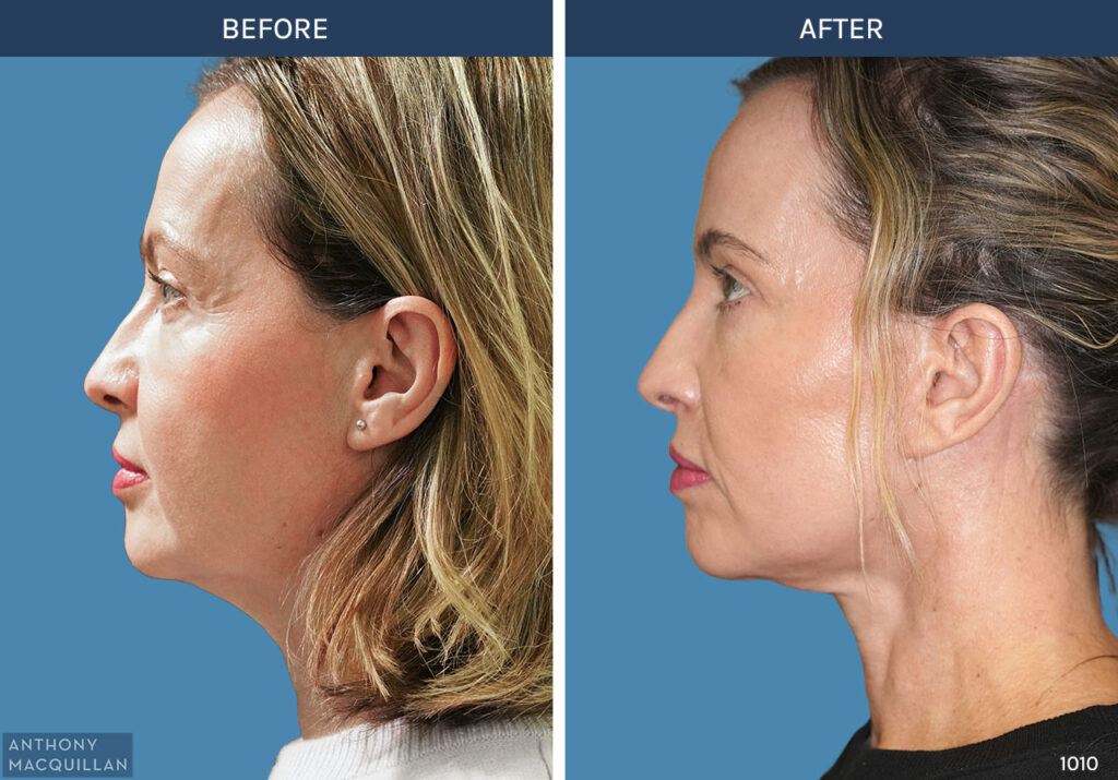 1010 - Deep Plane Face Lift with Deep Neck Lift by Anthony MacQuillan Side Left