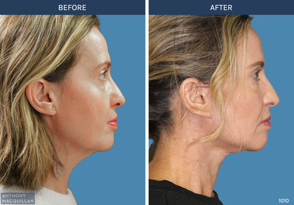 1010 - Deep Plane Face Lift with Deep Neck Lift by Anthony MacQuillan Side Right