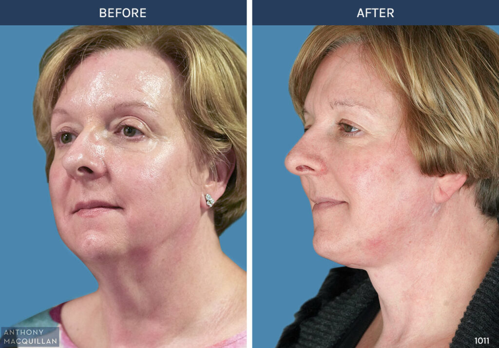 1011 - Deep Plane Face Lift with Deep Neck Lift by Anthony MacQuillan 45 Left