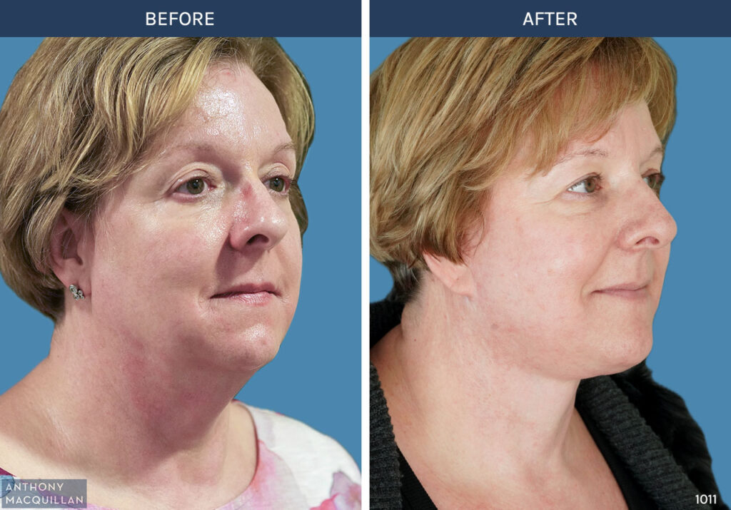 1011 - Deep Plane Face Lift with Deep Neck Lift by Anthony MacQuillan 45 Right
