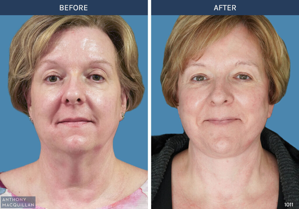 1011 - Deep Plane Face Lift with Deep Neck Lift by Anthony MacQuillan Front