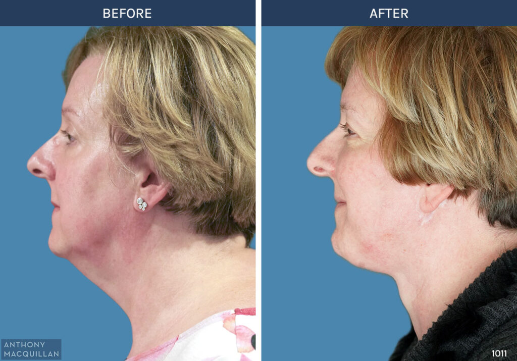 1011 - Deep Plane Face Lift with Deep Neck Lift by Anthony MacQuillan Side Left