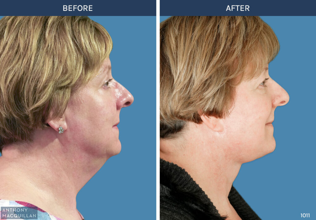 1011 - Deep Plane Face Lift with Deep Neck Lift by Anthony MacQuillan Side Right