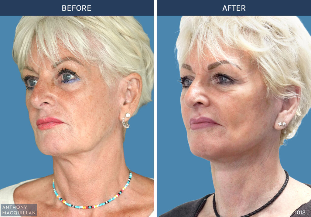 1012 - Deep Plane Face Lift with Deep Neck Lift by Anthony MacQuillan 45 Left
