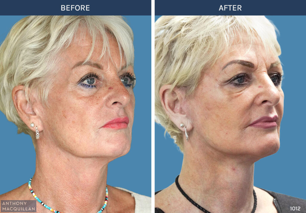 1012 - Deep Plane Face Lift with Deep Neck Lift by Anthony MacQuillan 45 Right