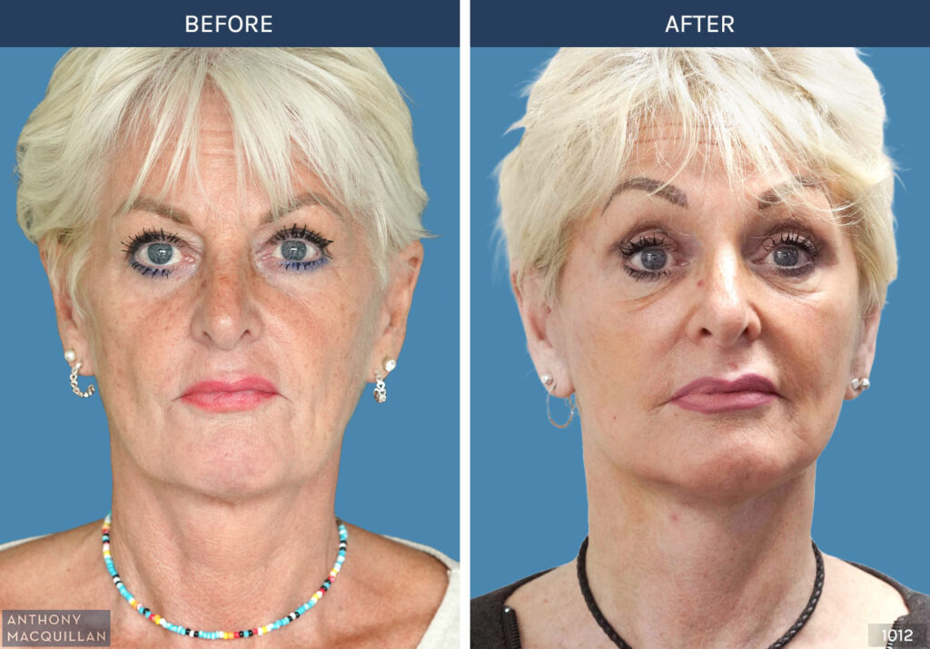1012 - Deep Plane Face Lift with Deep Neck Lift by Anthony MacQuillan Front