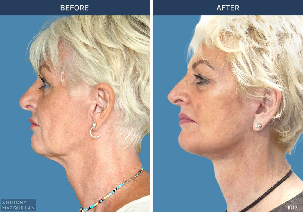 1012 - Deep Plane Face Lift with Deep Neck Lift by Anthony MacQuillan Side Left