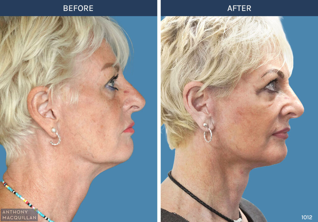 1012 - Deep Plane Face Lift with Deep Neck Lift by Anthony MacQuillan Side Right