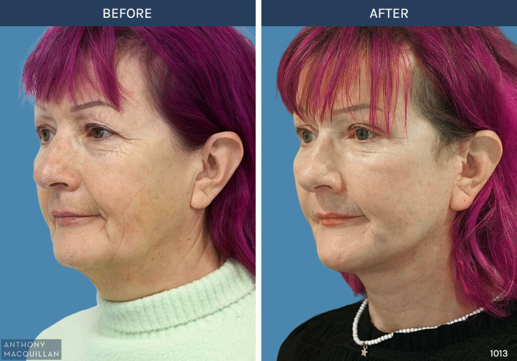 1013 - Deep Plane Face Lift with Deep Neck Lift by Anthony MacQuillan 45 Left