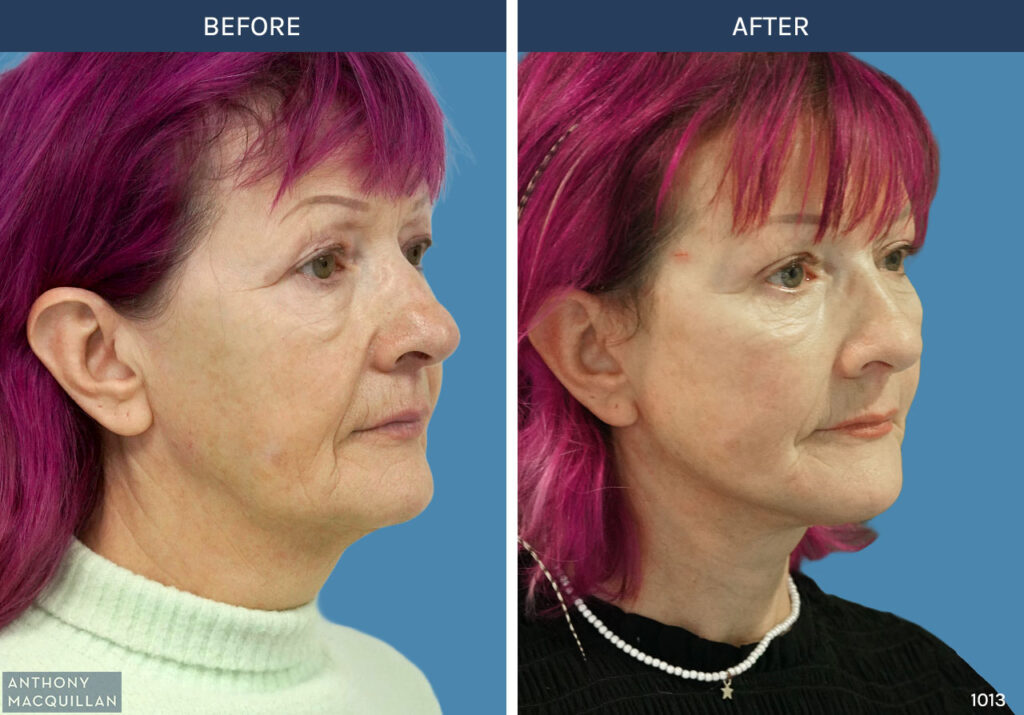 1013 - Deep Plane Face Lift with Deep Neck Lift by Anthony MacQuillan 45 Right