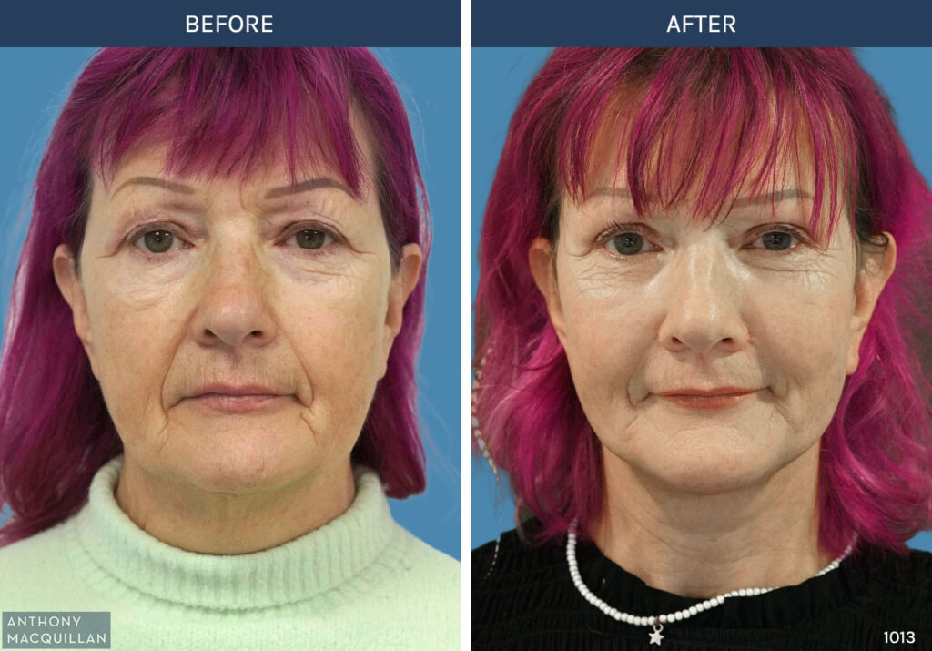 1013 - Deep Plane Face Lift with Deep Neck Lift by Anthony MacQuillan Front