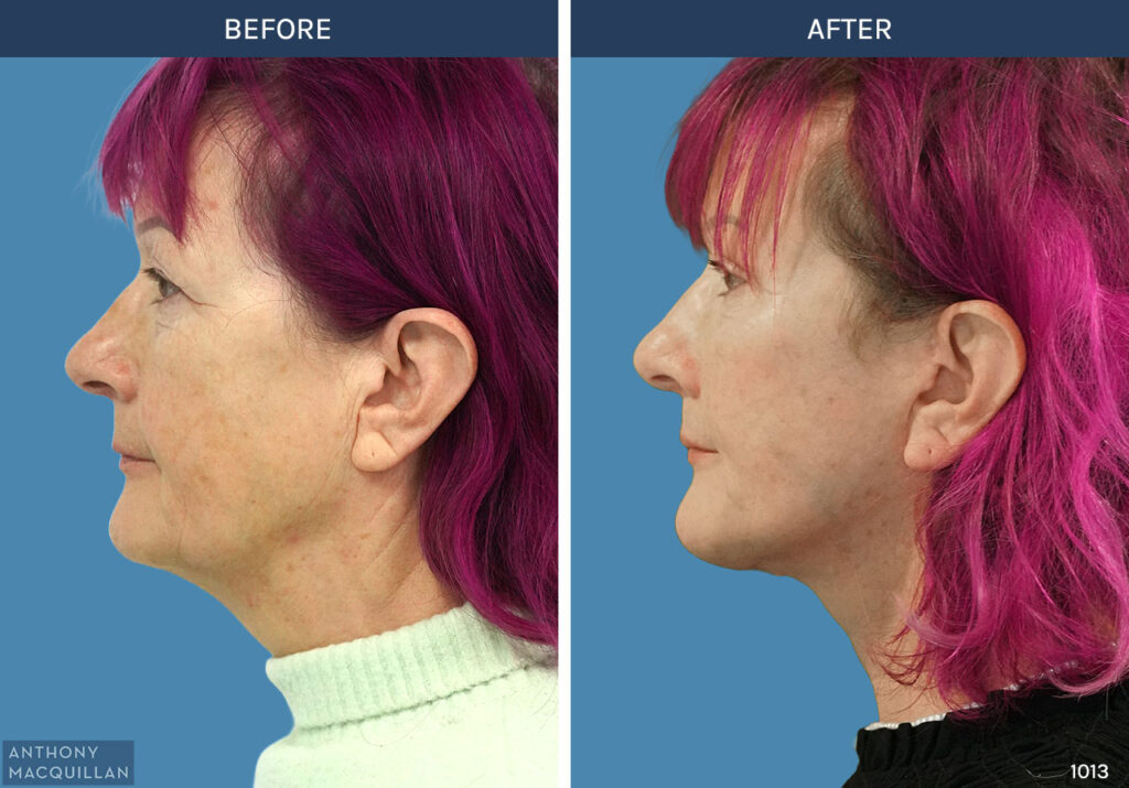 1013 - Deep Plane Face Lift with Deep Neck Lift by Anthony MacQuillan Side Left