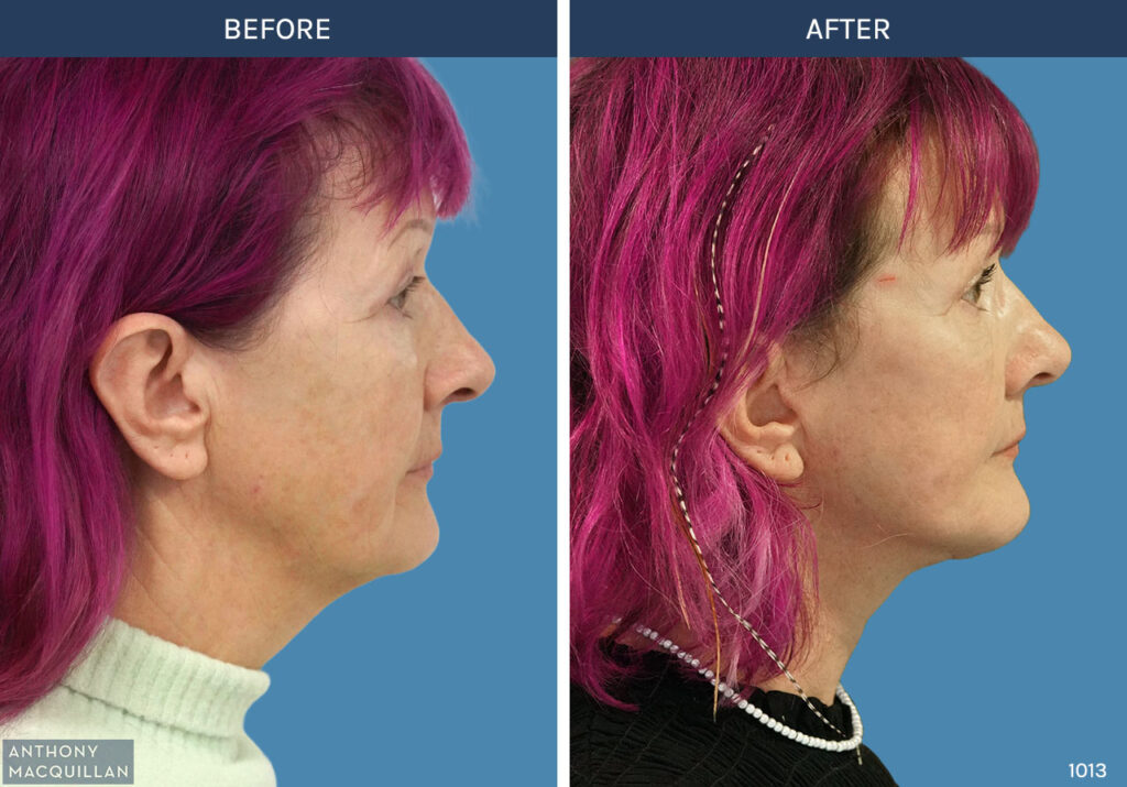1013 - Deep Plane Face Lift with Deep Neck Lift by Anthony MacQuillan Side Right