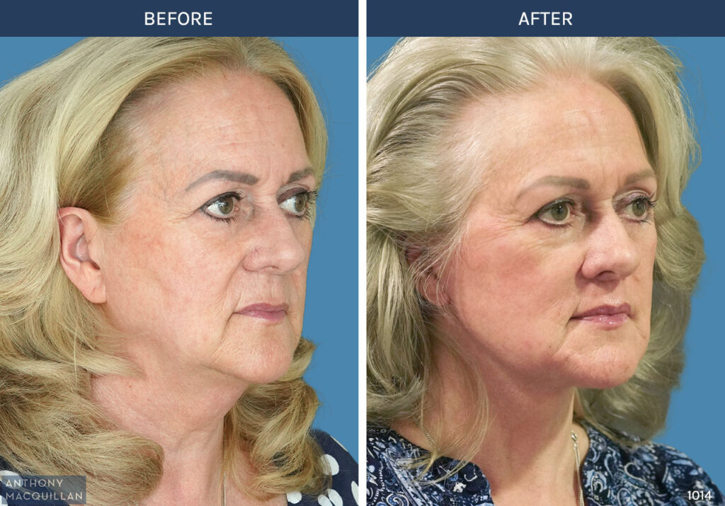1014 - Deep Plane Face Lift with Deep Neck Lift by Anthony MacQuillan 45 Right