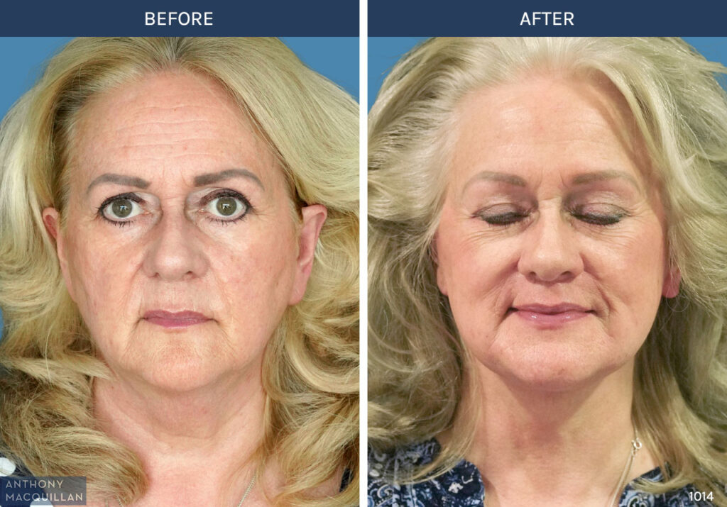 1014 - Deep Plane Face Lift with Deep Neck Lift by Anthony MacQuillan Front