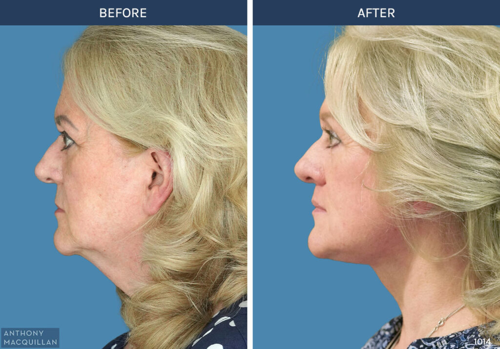 1014 - Deep Plane Face Lift with Deep Neck Lift by Anthony MacQuillan Side Left