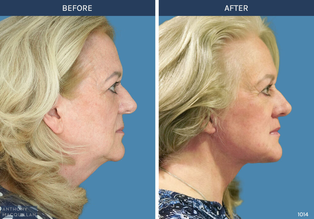 1014 - Deep Plane Face Lift with Deep Neck Lift by Anthony MacQuillan Side Right