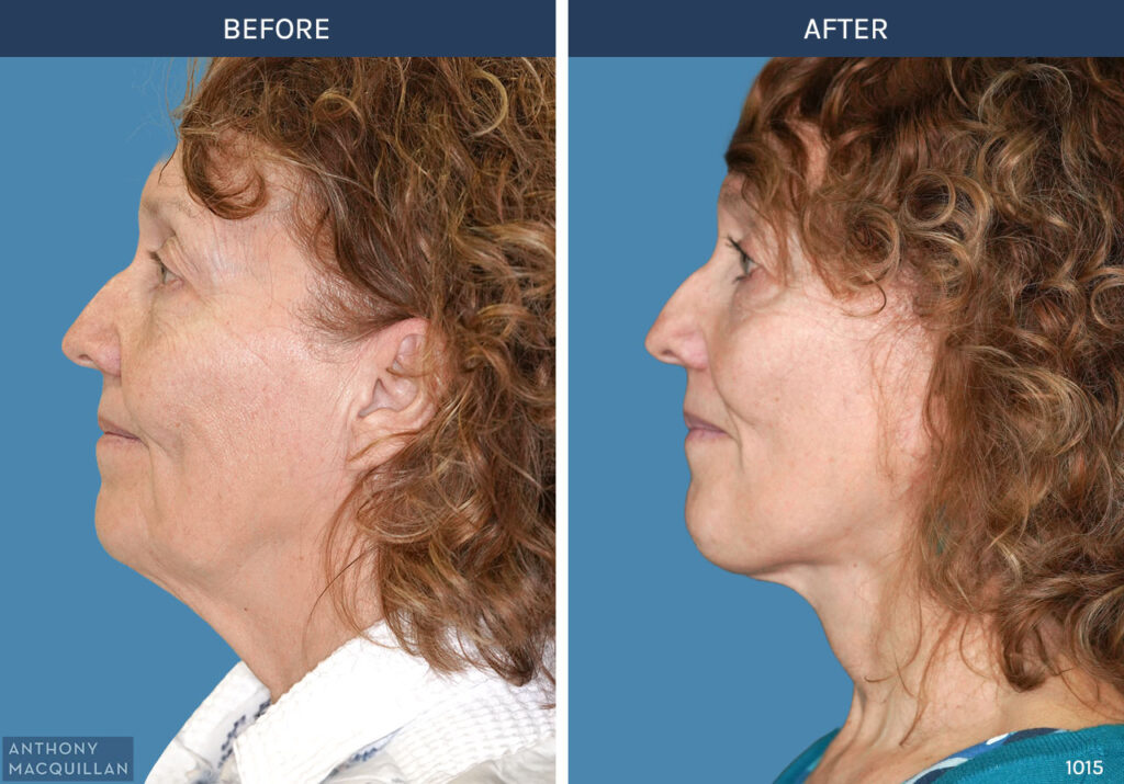 1015 - Deep Plane Face Lift with Deep Neck Lift by Anthony MacQuillan Side Left