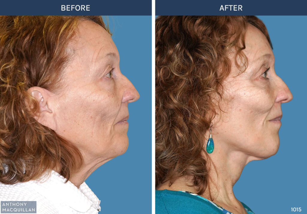 1015 - Deep Plane Face Lift with Deep Neck Lift by Anthony MacQuillan Side Right