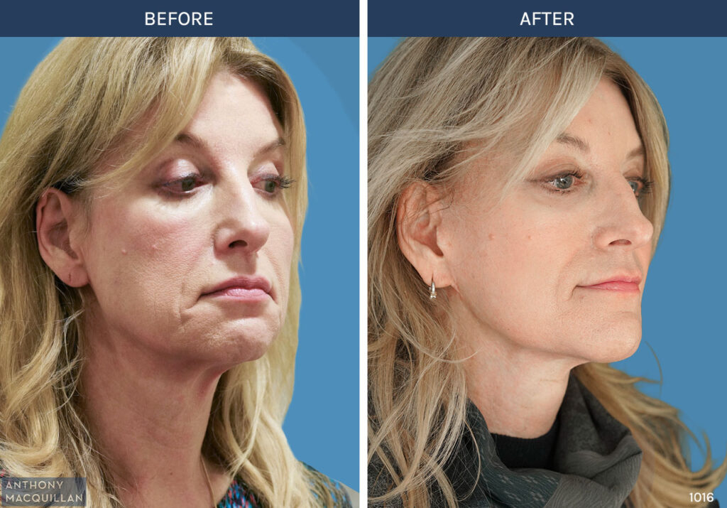 1016 - Deep Plane Face Lift with Deep Neck Lift by Anthony MacQuillan 45 Right