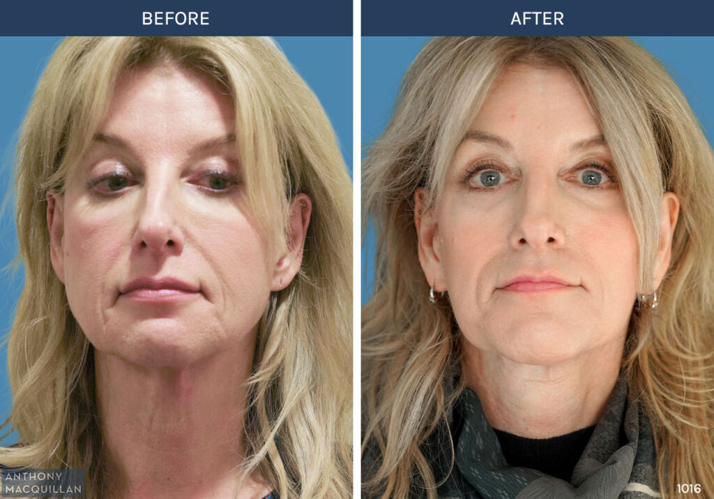 1016 - Deep Plane Face Lift with Deep Neck Lift by Anthony MacQuillan Front