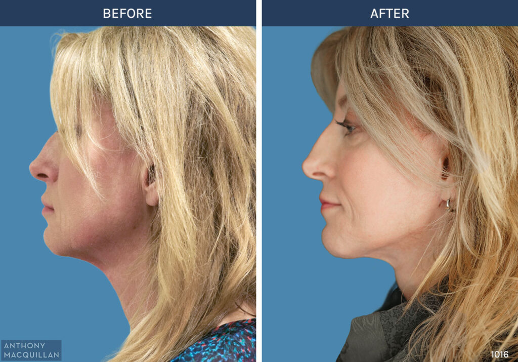 1016 - Deep Plane Face Lift with Deep Neck Lift by Anthony MacQuillan Side Left