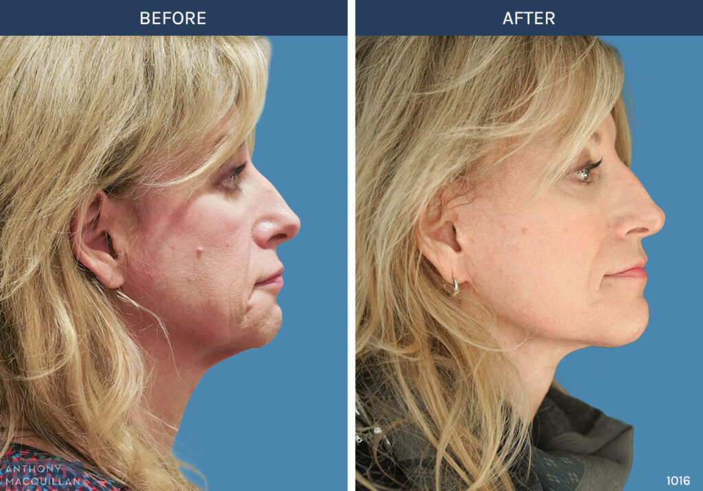 1016 - Deep Plane Face Lift with Deep Neck Lift by Anthony MacQuillan Side Right
