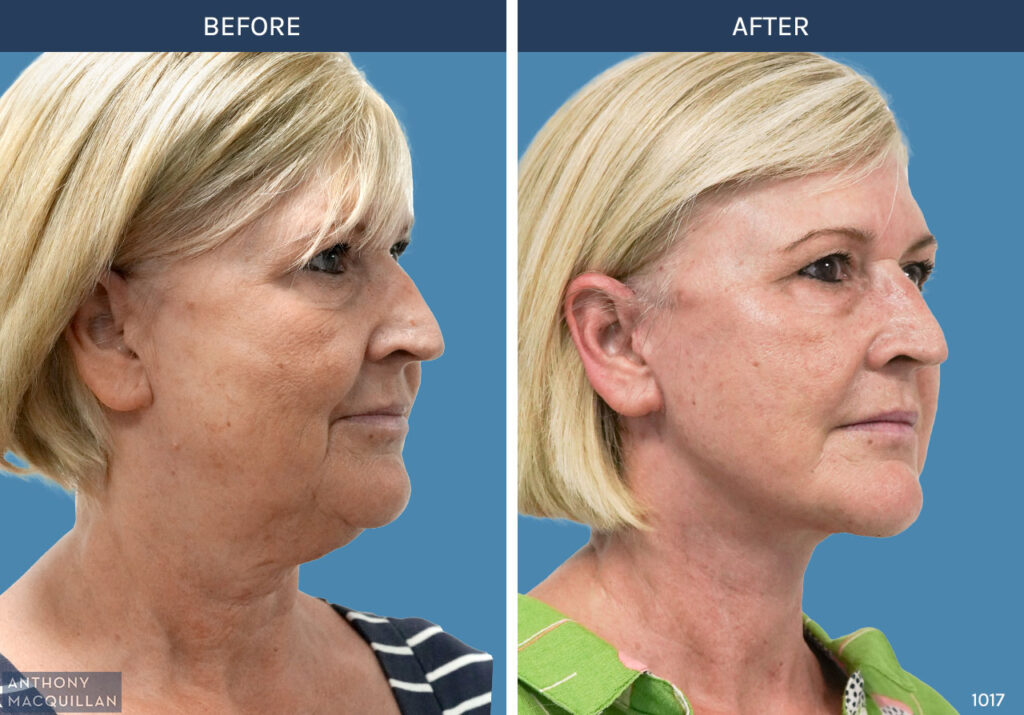 1017 - Deep Plane Face Lift with Deep Neck Lift by Anthony MacQuillan 45 Right