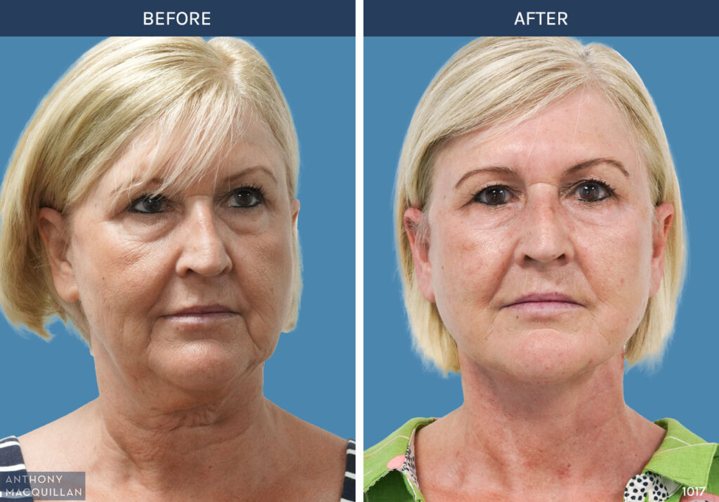 1017 - Deep Plane Face Lift with Deep Neck Lift by Anthony MacQuillan Front