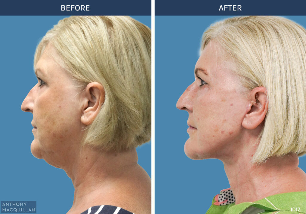 1017 - Deep Plane Face Lift with Deep Neck Lift by Anthony MacQuillan Side Left