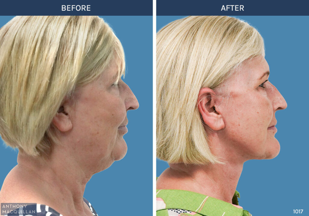 1017 - Deep Plane Face Lift with Deep Neck Lift by Anthony MacQuillan Side Right