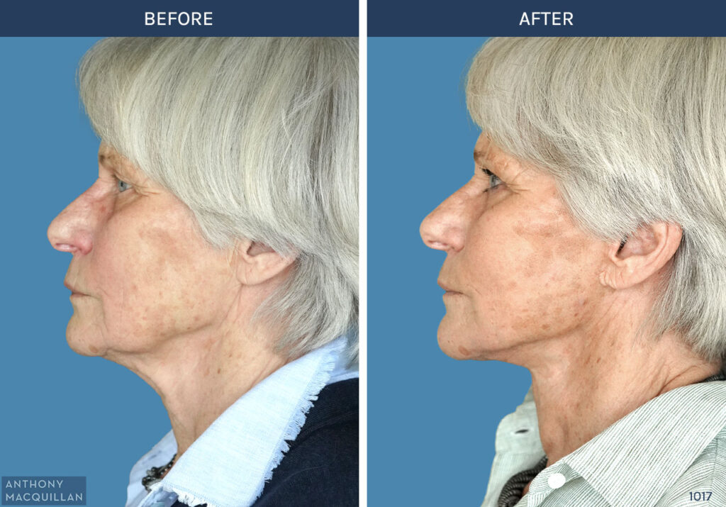 1018 - Deep Plane Face Lift with Deep Neck Lift by Anthony MacQuillan Side Left