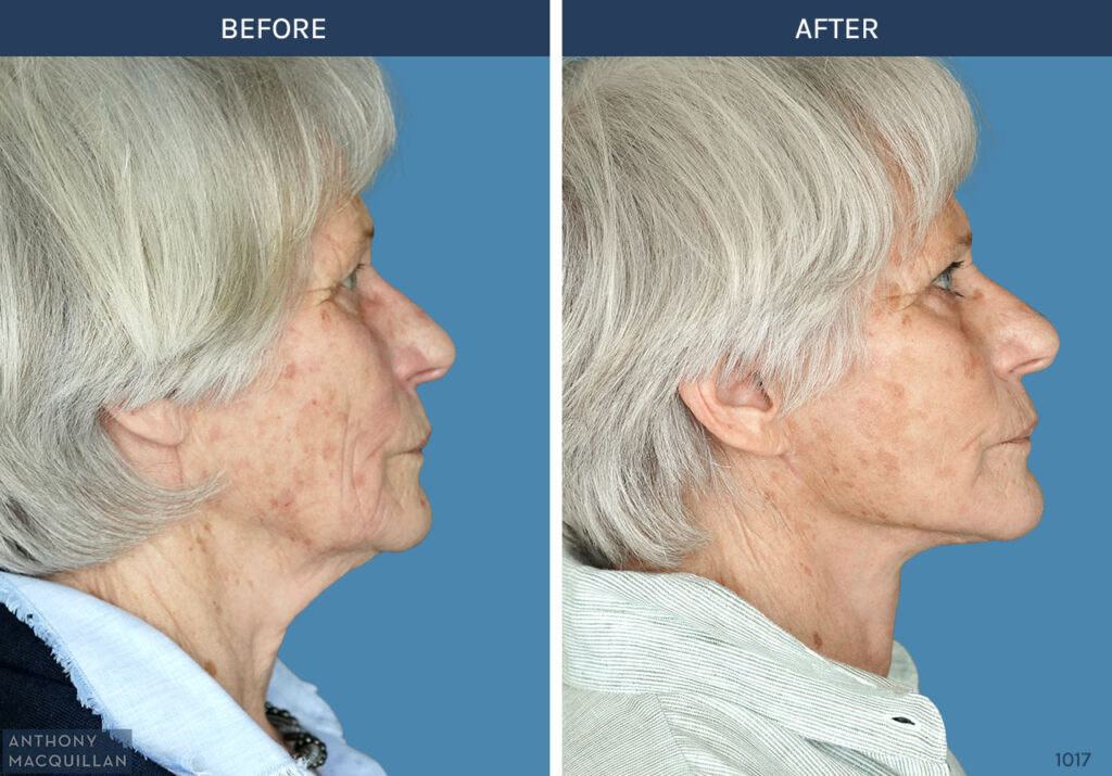 1018 - Deep Plane Face Lift with Deep Neck Lift by Anthony MacQuillan Side Right