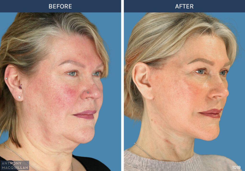 1019 - Deep Plane Face Lift with Deep Neck Lift by Anthony MacQuillan 45 Right