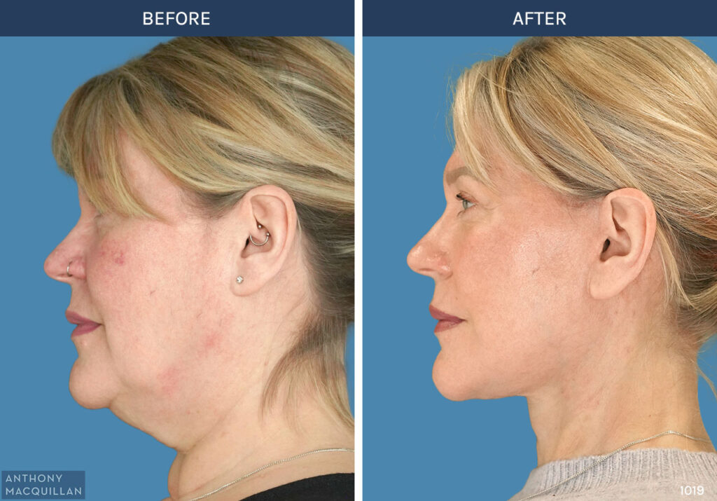 1019 - Deep Plane Face Lift with Deep Neck Lift by Anthony MacQuillan Front