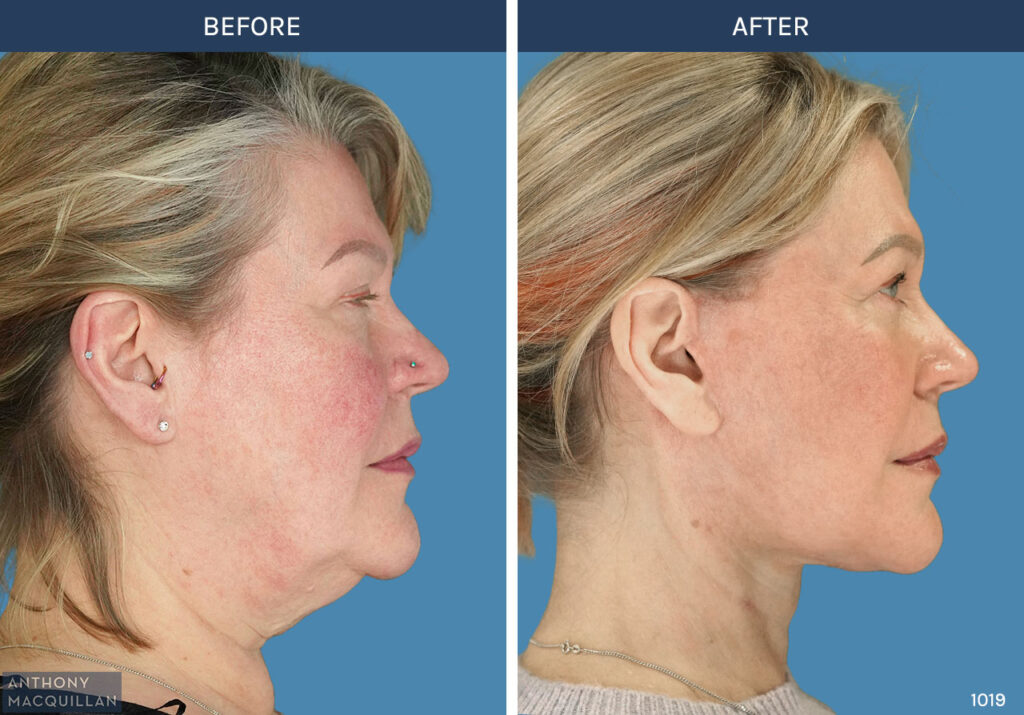 1019 - Deep Plane Face Lift with Deep Neck Lift by Anthony MacQuillan Side Right