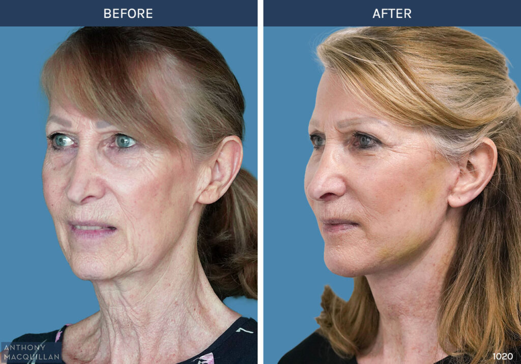 1020 - Deep Plane Face Lift with Deep Neck Lift by Anthony MacQuillan 45 Left