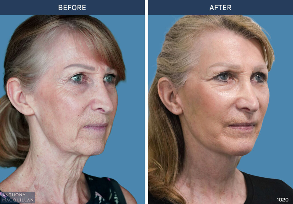 1020 - Deep Plane Face Lift with Deep Neck Lift by Anthony MacQuillan 45 Right
