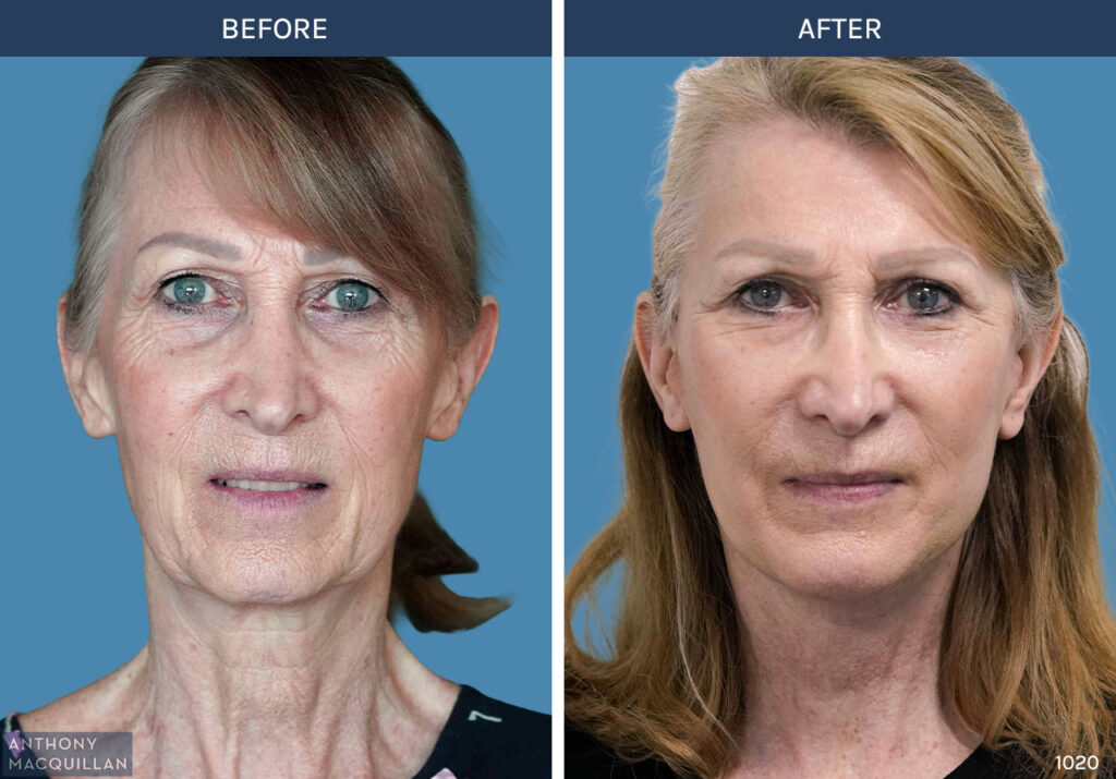 1020 - Deep Plane Face Lift with Deep Neck Lift by Anthony MacQuillan Front