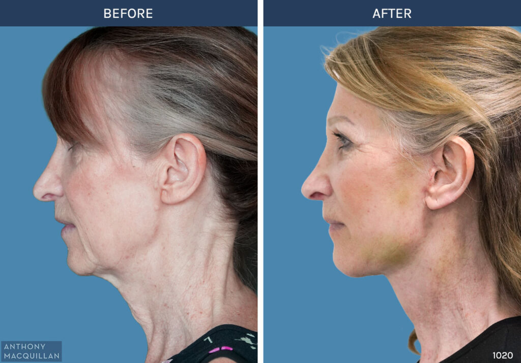 1020 - Deep Plane Face Lift with Deep Neck Lift by Anthony MacQuillan Side Left