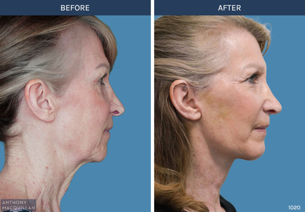 1020 - Deep Plane Face Lift with Deep Neck Lift by Anthony MacQuillan Side Right