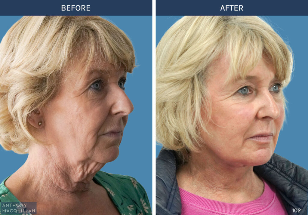 1021 - Deep Plane Face Lift with Deep Neck Lift by Anthony MacQuillan 45 Right