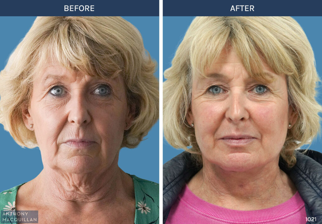 1021 - Deep Plane Face Lift with Deep Neck Lift by Anthony MacQuillan Front