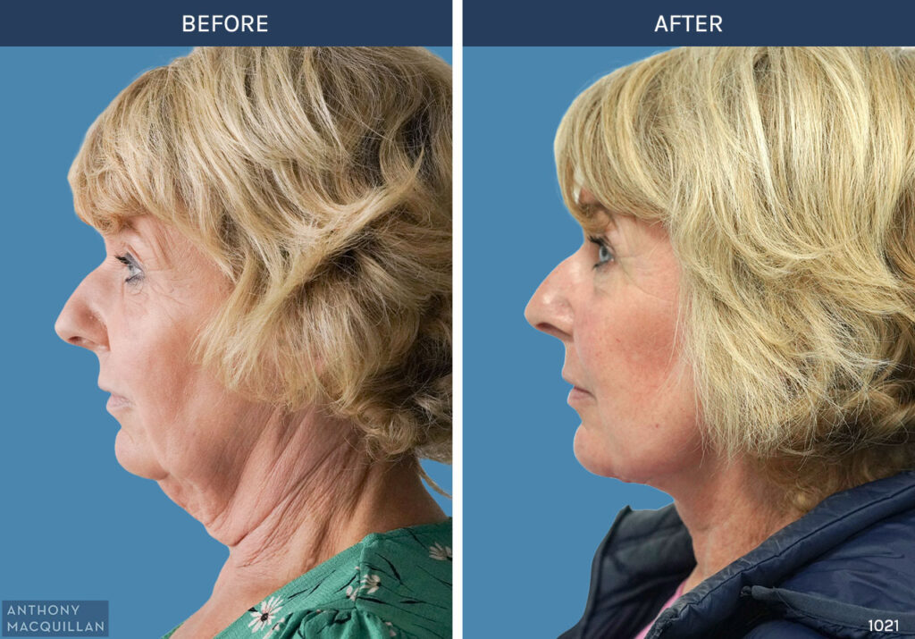 1021 - Deep Plane Face Lift with Deep Neck Lift by Anthony MacQuillan Side Left