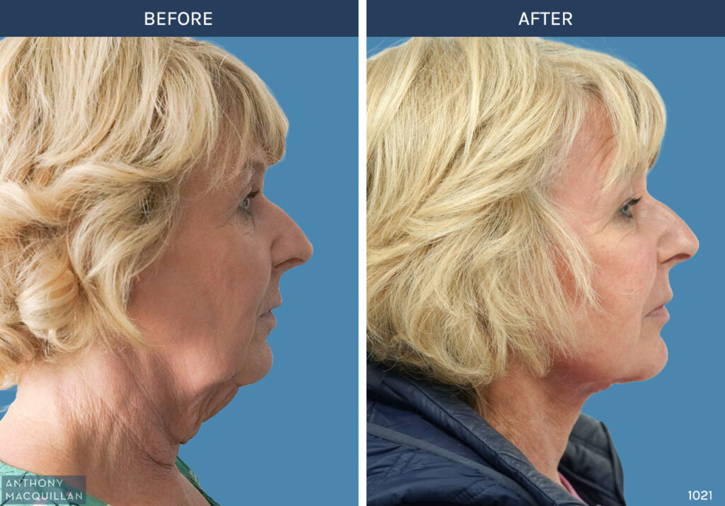 1021 - Deep Plane Face Lift with Deep Neck Lift by Anthony MacQuillan Side Right