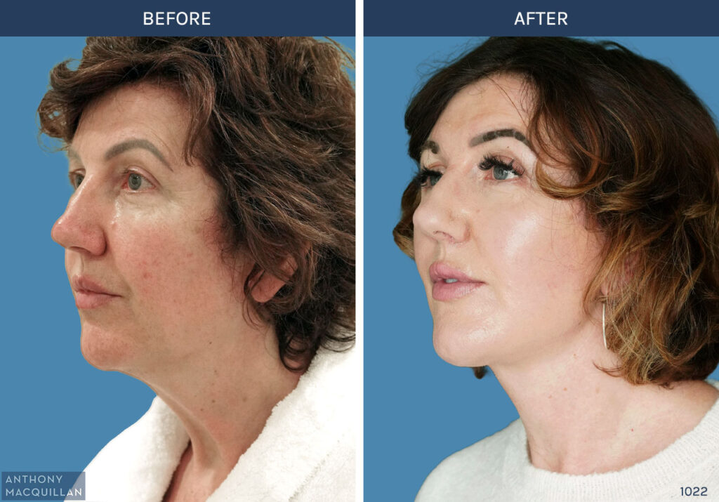 1022 - Deep Plane Face Lift with Deep Neck Lift by Anthony MacQuillan 45 Left
