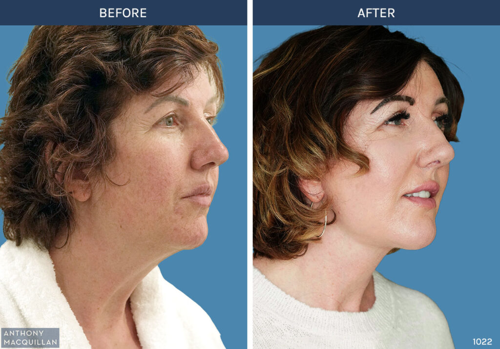 1022 - Deep Plane Face Lift with Deep Neck Lift by Anthony MacQuillan 45 Right