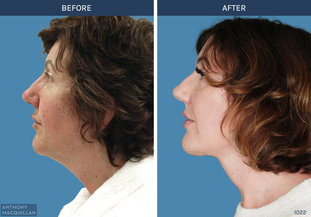 1022 - Deep Plane Face Lift with Deep Neck Lift by Anthony MacQuillan Side Left